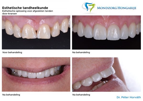 Esthetische tandheelkunde - Mondzorg Hongarije